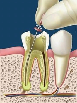 Endodoncia en Villanueva de la Serena