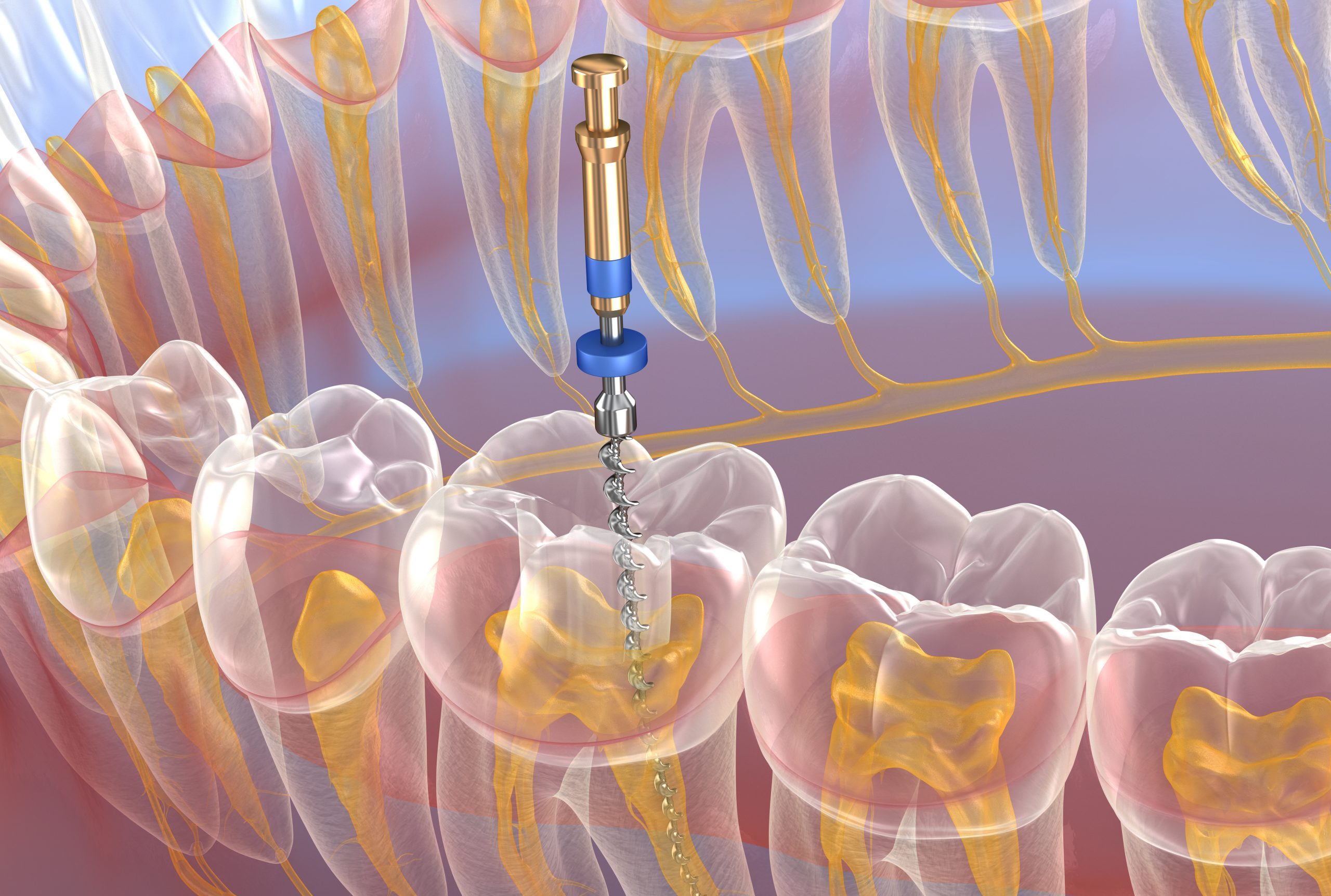 Tratamiento de endodoncia en Villanueva de la Serena en nuestra clínica dental
